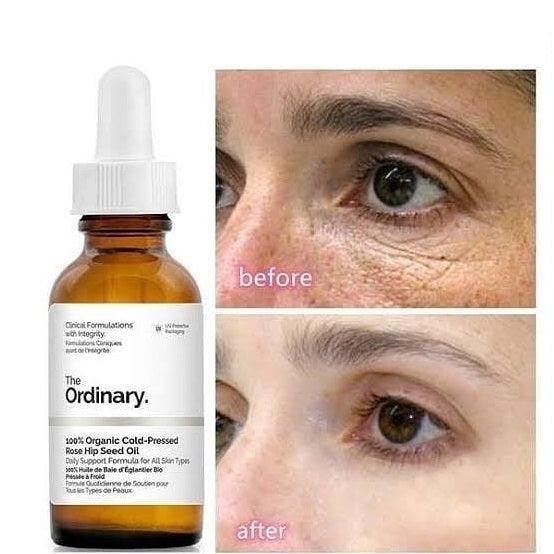 (Bill Mỹ) - Tinh dầu The Ordinary 100% Organic Cold-Pressed Rose Hip Seed Oil